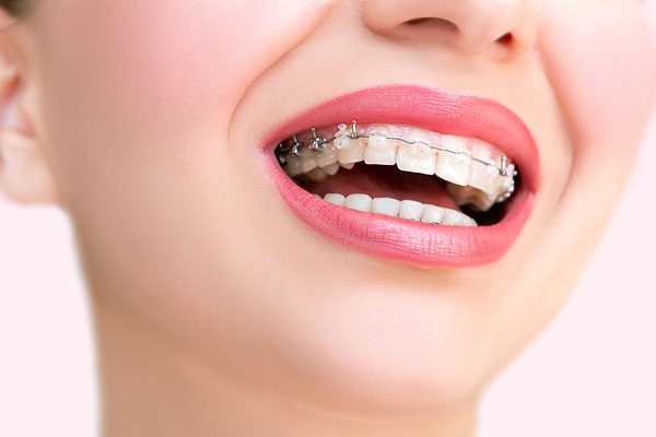 How Long Does Treatment With Clear Braces Normally Take?